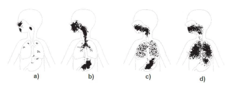 research on how nebulizer and children’s bad behavior affect the therapy effect
